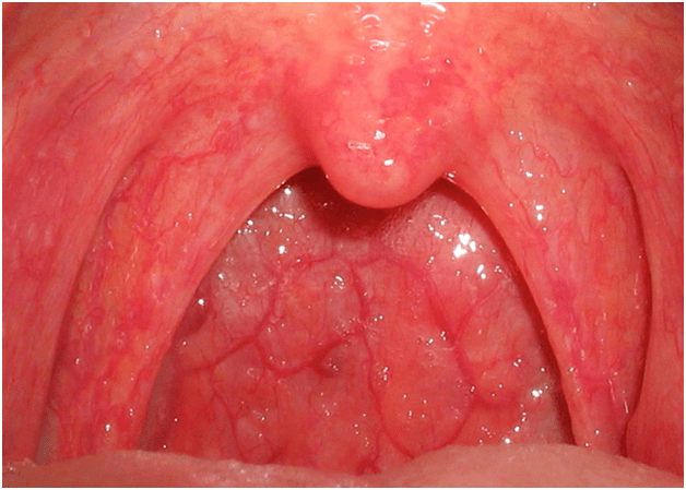 Белые и красные волдыри на задней стенке горла и миндалине