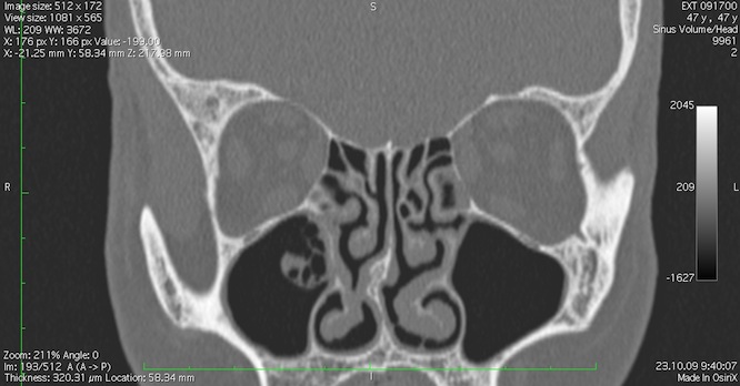 Обследование околоносовых пазух при помощи компьютерной томографии