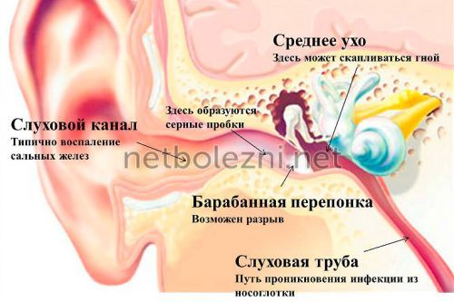 Как удалить серную пробку из уха самостоятельно в домашних условиях