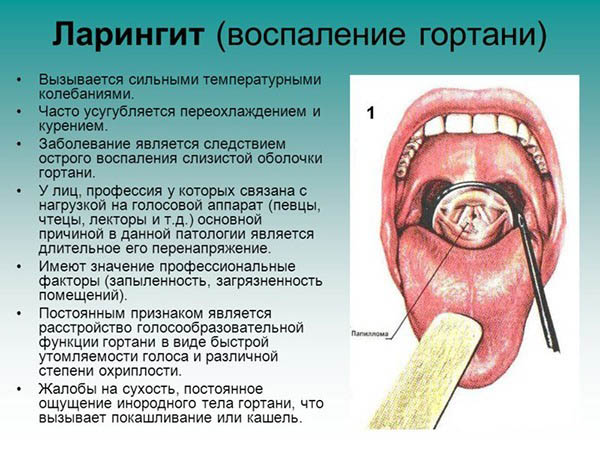 Симптомы и причины ларингита