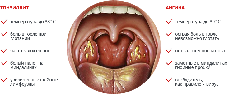 Чем отличается ангина от тонзиллита