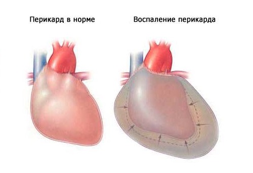 Причины и лечение надсадного кашля