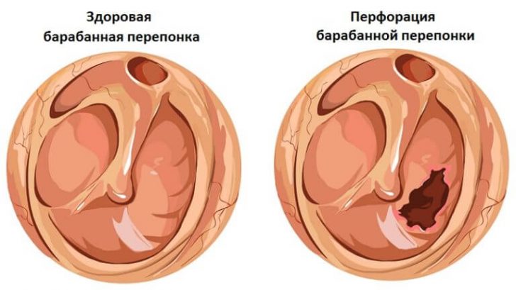 Особенности повреждения барабанной перепонки