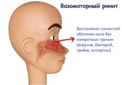 Причины и лечение постоянного насморка, как избавиться, что делать