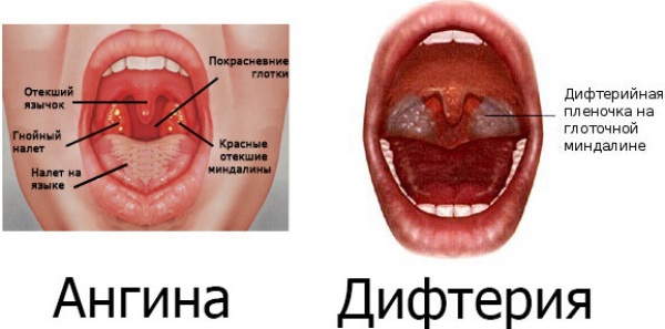 Чем ангина отличается от дифтерии