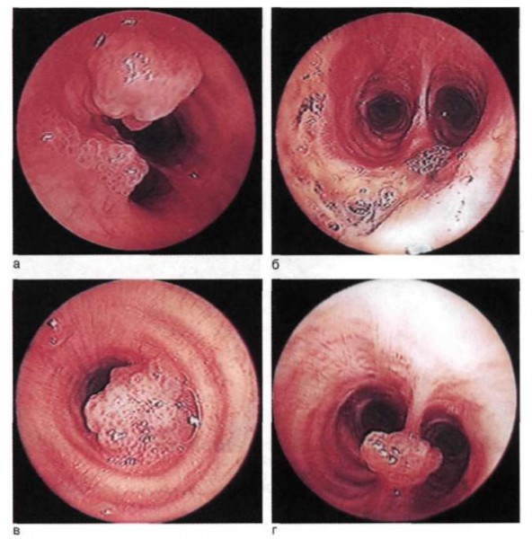 Рецидив папиллом трахеи