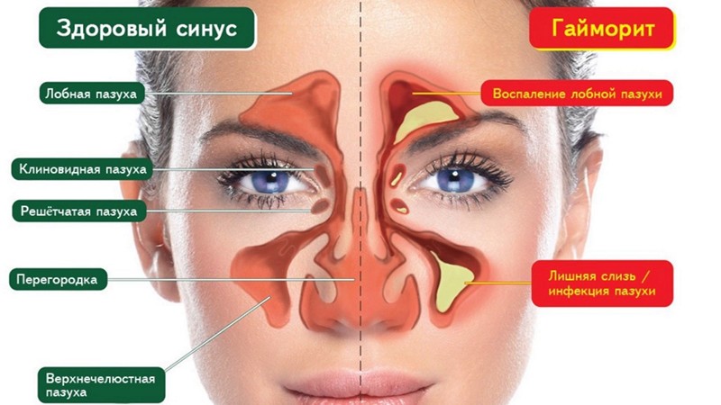 Симптомы и лечение гайморита у детей раннего и дошкольного возраста 2-7 лет