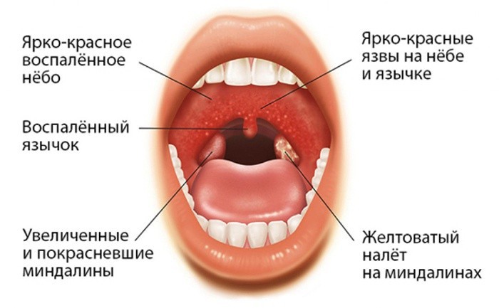 Может ли быть ангина без температуры