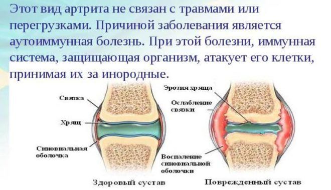 Скарлатина у ребёнка