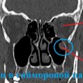 Обследование околоносовых пазух при помощи компьютерной томографии