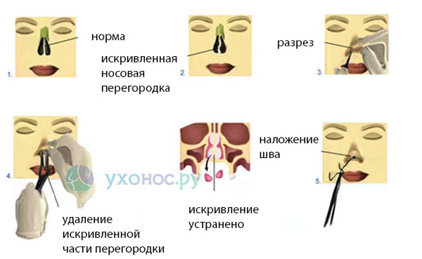 этапы проведения септопластики