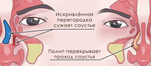 Симптомы и лечение двухстороннего синусита