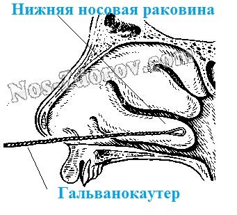 Когда требуется выполнить процедуру прижигания сосудов в носу