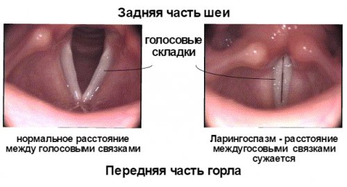 Эффективные антибиотики при ларингите у взрослых и детей