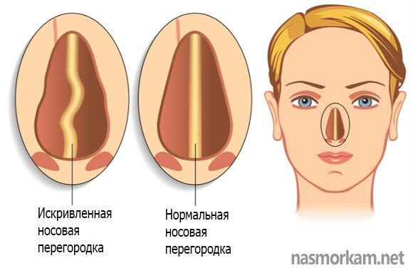 Септопластика носовой перегородки показания и противопоказания к проведению операции
