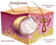 Шарик или шишка в мочке уха