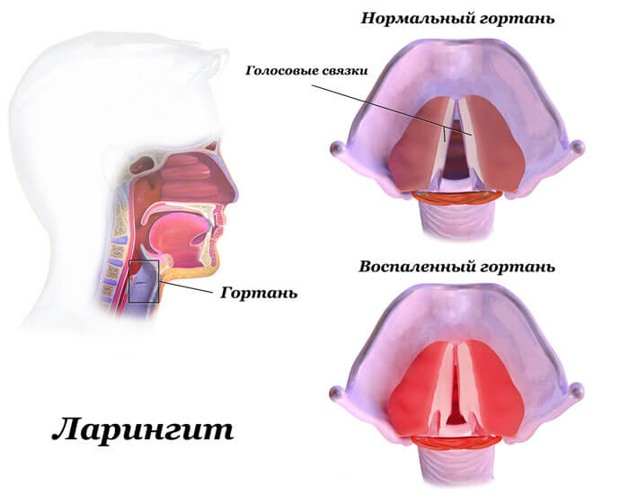 Самые эффективные рецепты для лечения фарингита народными средствами