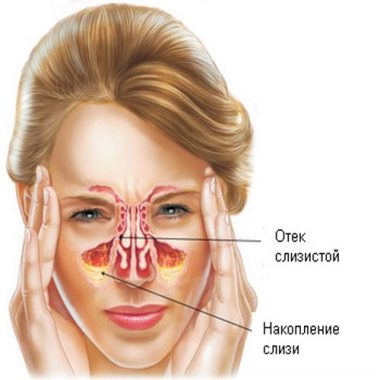 Гайморит симптомы и лечение у взрослых без пункции на дому
