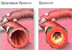 Сильный кашель ночью