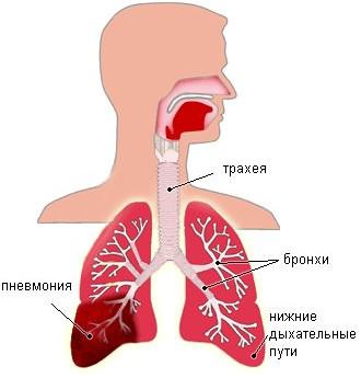 Кашель при пневмонии у взрослых