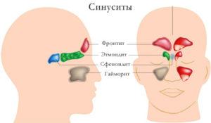 Симптомы и лечение двухстороннего синусита