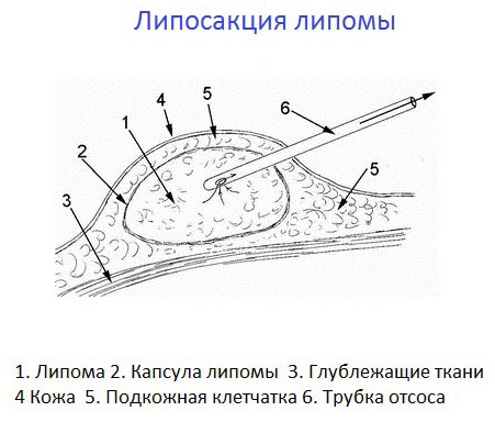 Причины появления жировика за ухом