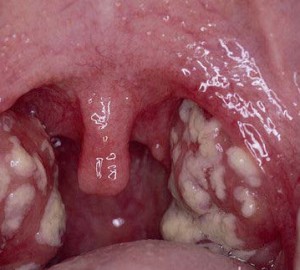 Лечение стоматита на миндалинах у взрослых