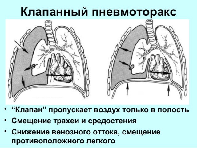 Пневмоторакс легкого