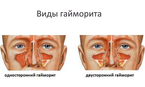 С чем лучше делать домашние ингаляции при гайморите