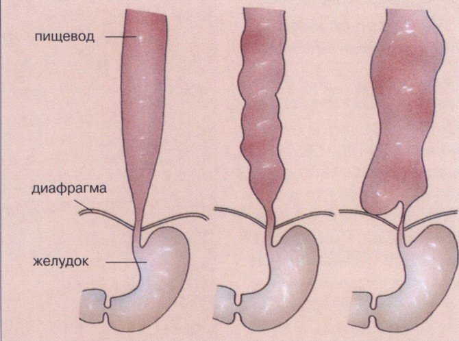 Спазмы горла и панические атаки