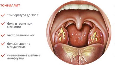 Все о лечении тонзиллита