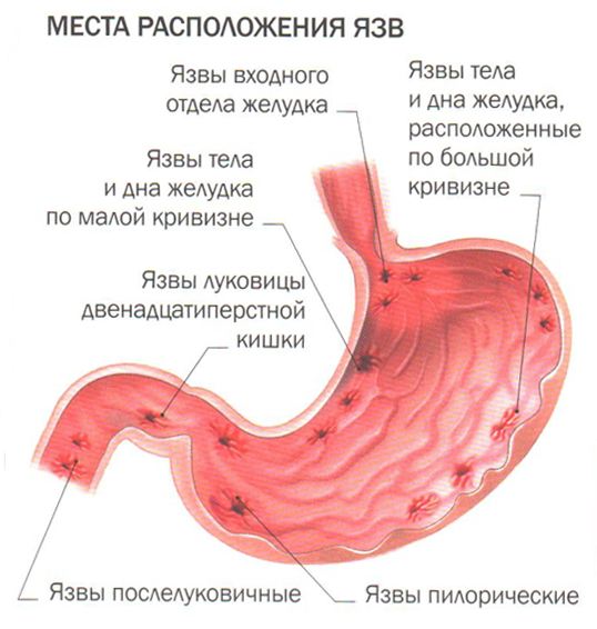 Возможные места локализации язв желудка