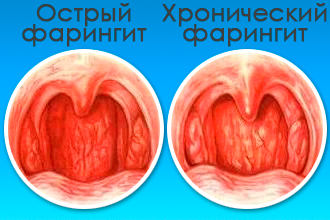 Как вылечить воспаление задней стенки горла