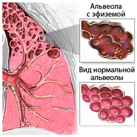 Лечение и профилактика воспаления бронхов