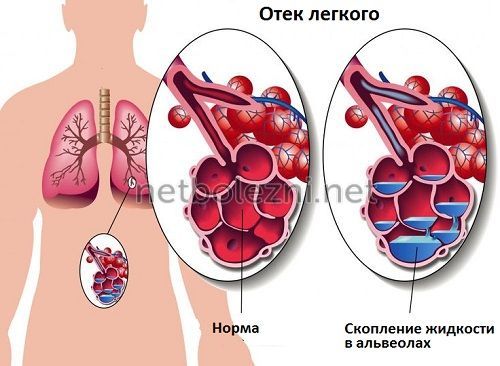 Как лечить кашель со рвотой у взрослого