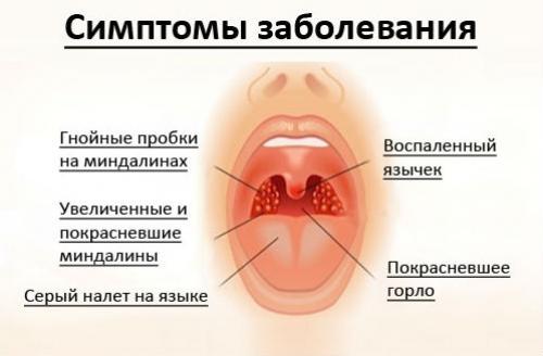 Симптомы, лечение и причины отека гортани у взрослых, оказание первой помощи