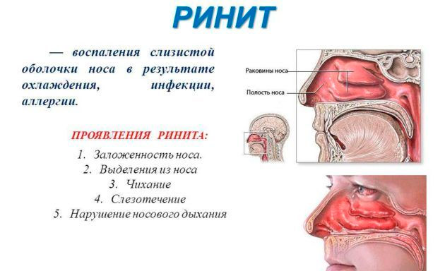 Можно ли капать в нос при насморке Левомицетин