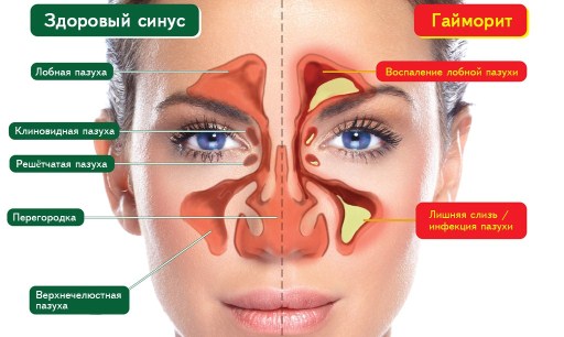 Гайморит у беременных