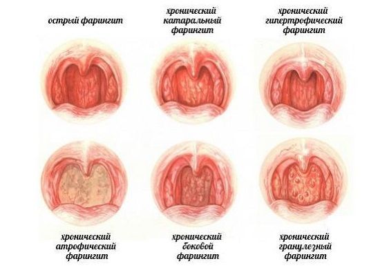 Заболевания горла и гортани симптомы и лечение болезни