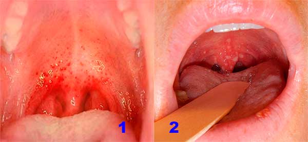 везикулы в горле при герпангине