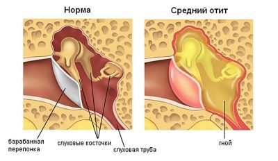 Как понять по симптомам, что у грудничка болит ухо