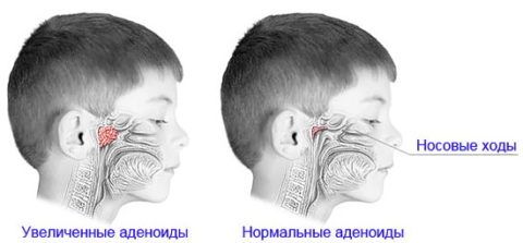 По каким причинам проводить ингаляции при аденоидах у детей