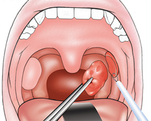Способы лечения и осложнения при кисте миндалины