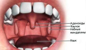 Аденоиды — это разрастание лимфоидной ткани глоточной миндалины