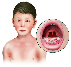 Скарлатина у ребёнка