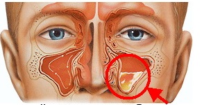 Какие признаки и как лечить катаральный синусит