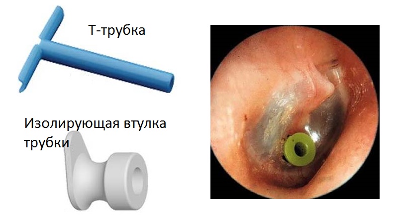 Баротравма уха