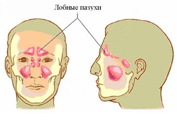 Заболевания лобных пазух