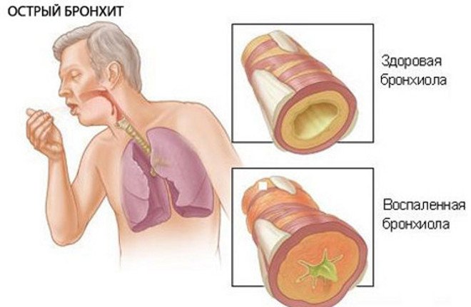 Бронхит у детей без температуры