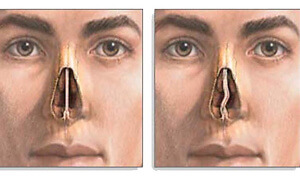 Последствия кривой перегородки носа и способы лечения патологии